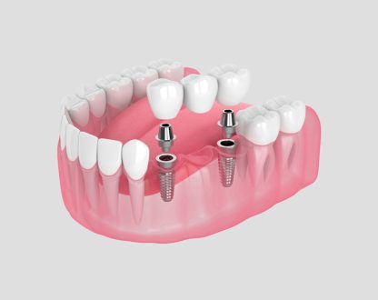 Why Choose Dental Implants for Long-Term Stability